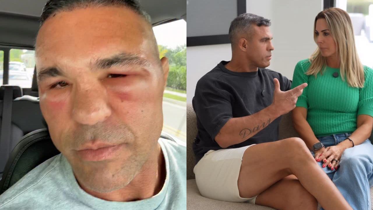Vitor Belfort mostra rosto inchado após procedimento e faz comentário