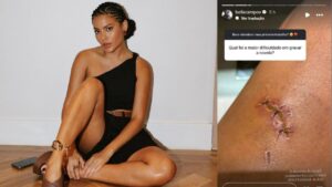 Bella Campos mostra como ficou a perna depois da mordida de jacaré!