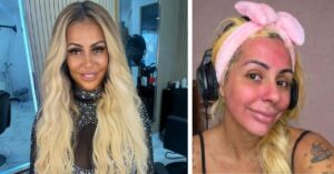 Ex-Miss Bumbum tem reação alérgica após skincare com sangue